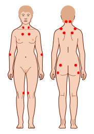 Resultado de imagem para fibromyalgi punkter